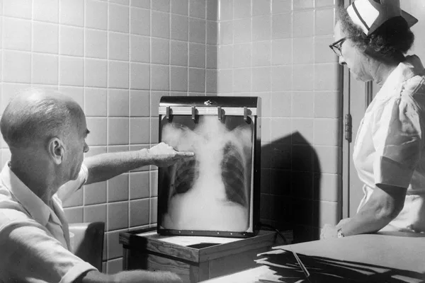 AI tool developed for pediatric TB screening using 2,000 X-rays