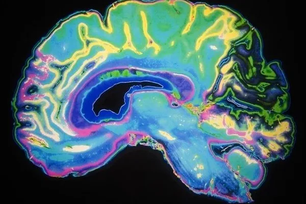 AI model detects hidden multiple sclerosis lesions