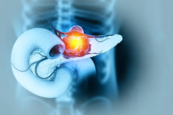 New antibody treatment targets hard-to-reach pancreatic cancer protein