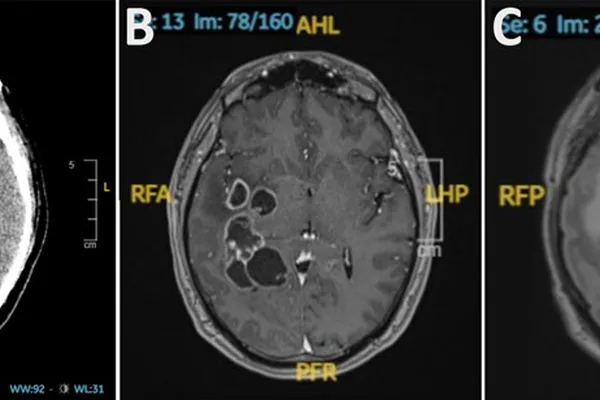 Doctors misdiagnose brain cancer, find parasitic worms instead