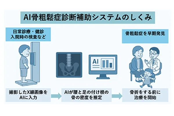 AI系统利用腰椎X光片辅助骨质疏松诊断
