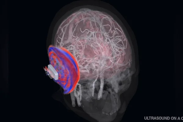 Aleph Neuro & Butterfly Network achieve high-res brain imaging with ultrasound-on-a-chip