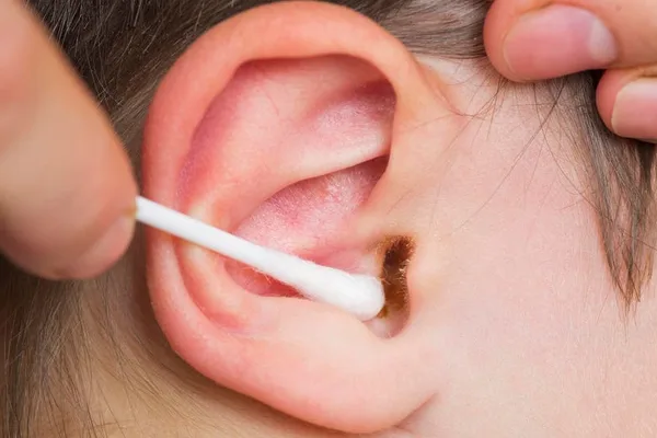 Biologists explain earwax function and genetic variations