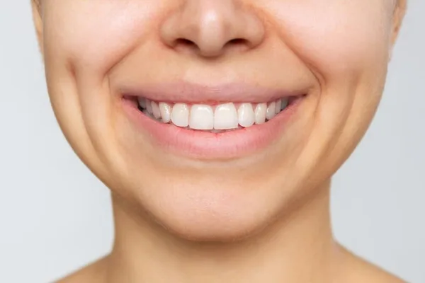 Smile dimples: Not a simple gene, but a muscle variation